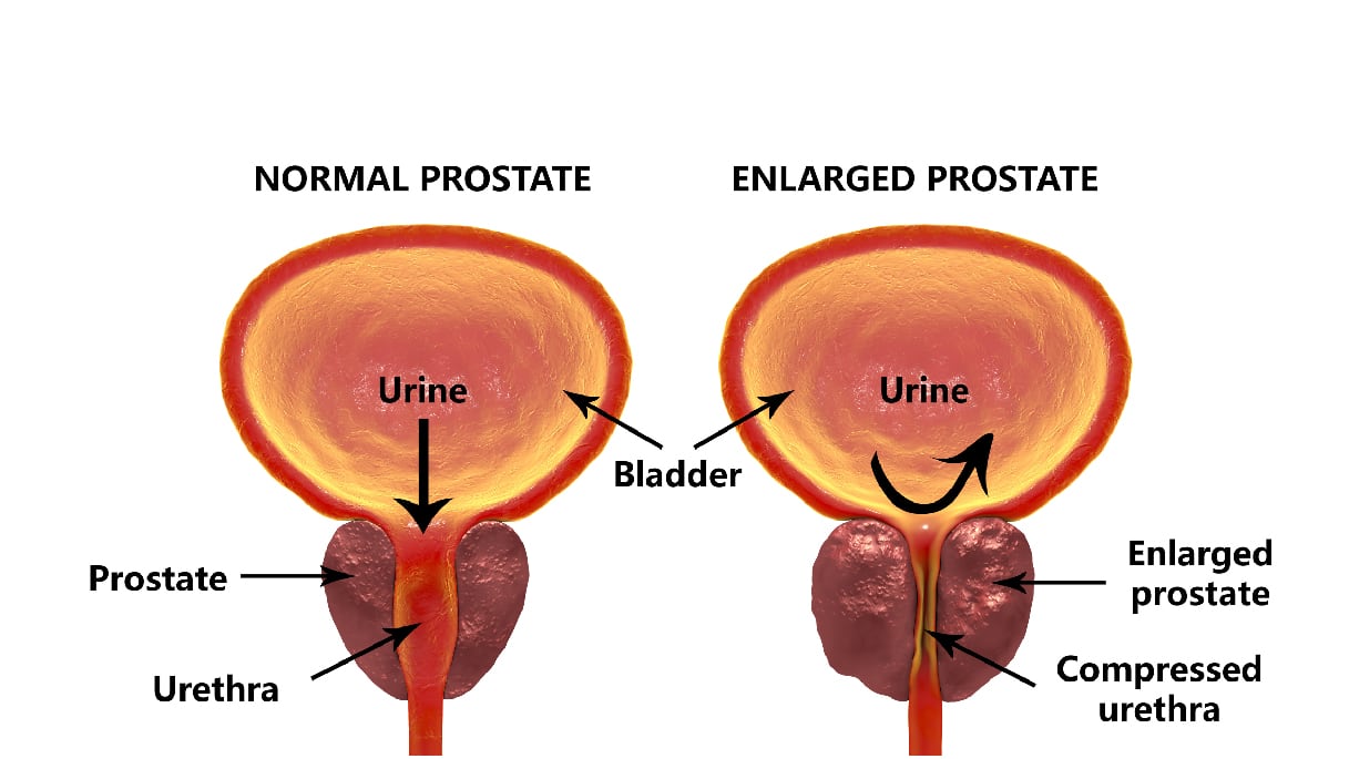 bad prostate numbers